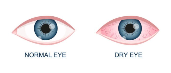Dry Eye Syndrome: What Is It?