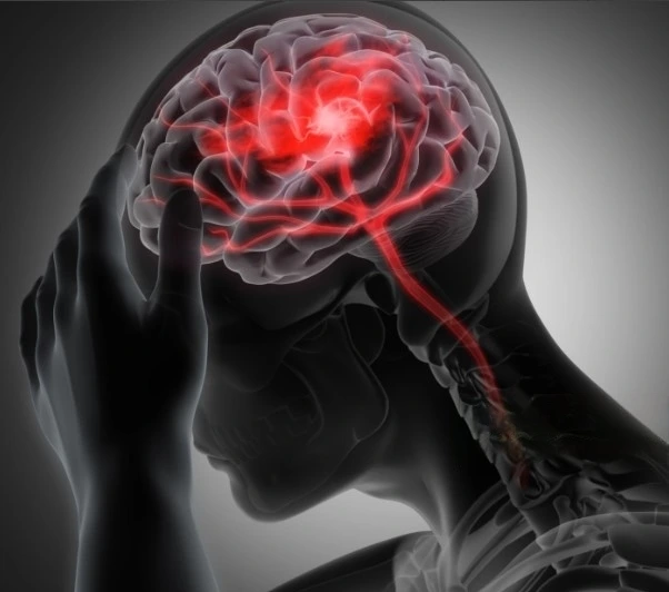 Migrane Migraine Headaches